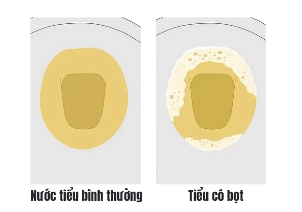 Dấu hiệu bất thường của nước tiểu