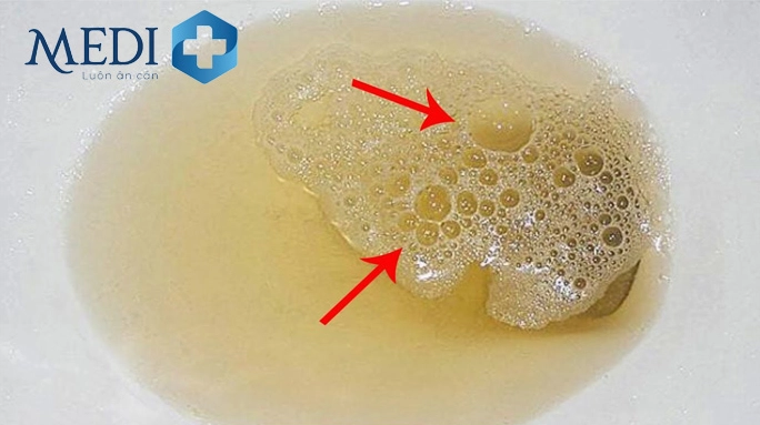Tốc độ dòng chảy nước tiểu nhanh gây bọt